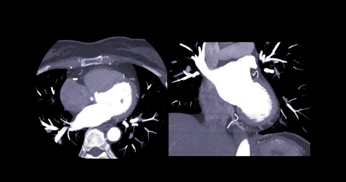 CTA Coronary Artery Or Cardiac CT For Diagnosis Coronary Artery Diseases.