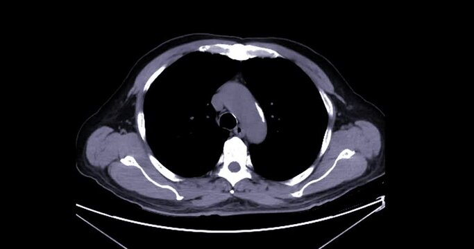 CT Chest and abdomen with contrast media for diagnosis chest and  abdominal pain.