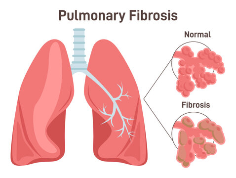 Pulmonary fibrosis. Lung tissue disease. Damaged, thickened