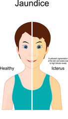 Jaundice. The Comparison between Healthy person and person with Icterus.