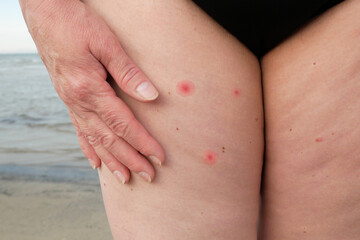 Mosquito bites cause allergies in woman skin in sea beach. Itchy skin. swollen mosquito bite on...