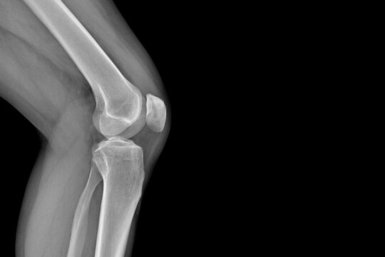 X-ray of the knee joints, an image of the knee bones on an X-ray. clear picture of the patient, arthritis, fluid in the joint, musculoskeletal system, skeleton, image of the disease