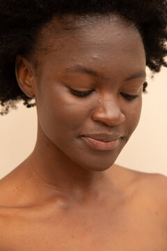 Beautiful girl with some acne