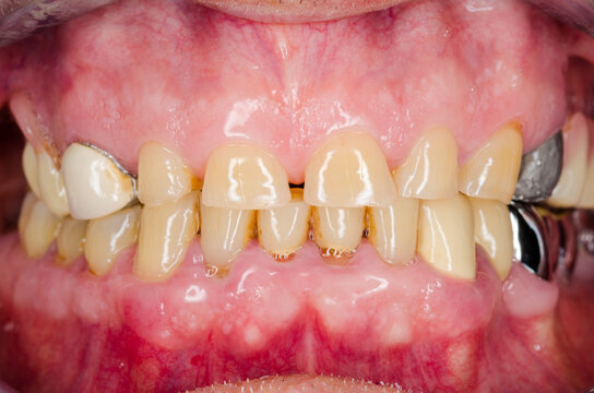oral situation with abrasions and lost  occlusal height