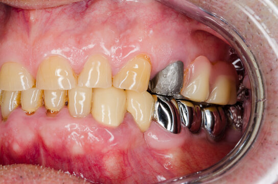 oral situation with abrasions and lost  occlusal height