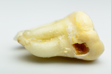Tooth with caries - macro photo. Tooth decay with enamel and dentin caries, pulpits and periodontists. White background.