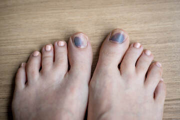 Feet in need of treatments, injuries and nail bruising. Concept, illustrative of need for health...