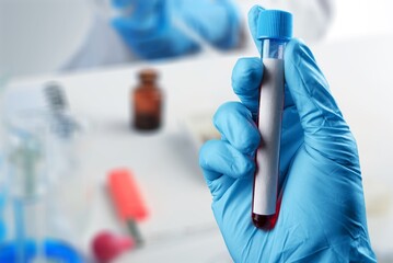 Positive blood infection sample in test tube for CENTAURUS BA 2.75 omicron covid19 coronavirus in...