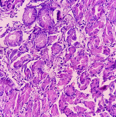 Microscopic image of stomach body(Biopsy), Hyperplastic polyp. Show gastric mucosa, polypoid growth of dilated gastric gland and oedematous stroma.