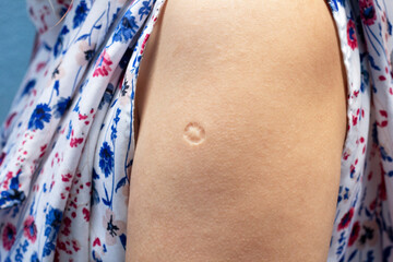 Bacillus Calmette-Guern Vaccine,  BCG or TB vaccine scar mark at the arm of Southeast Asian women. - obrazy, fototapety, plakaty
