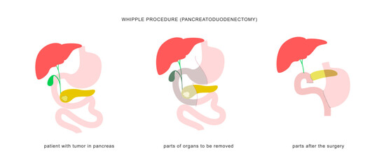 Medical infographic of whipple procedure pancreaticoduodenectomy with gastrojejunostomy. Surgery operation in treatment of pancreatic cancer.