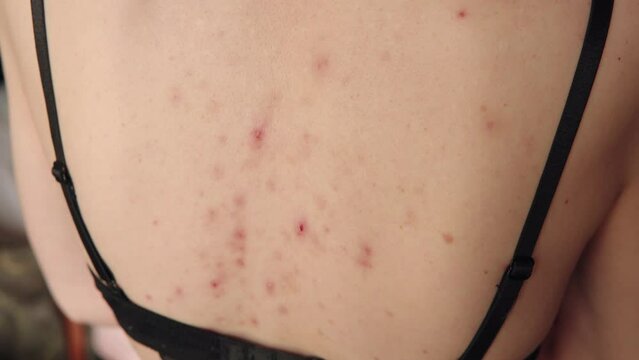 Detailed view of problematic skin, acne sequelae, torn pimples, skin itching on the back.
