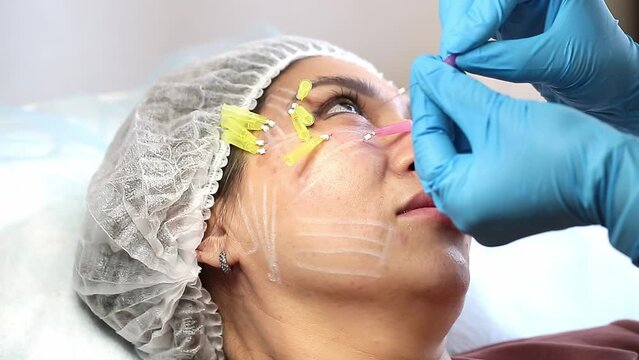 Thread lifting is a cosmetological procedure for face rejuvenation. The beautician implants cosmetic threads under the skin to relieve facial ptosis.