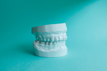 Plaster mould of human jaw with transparent aligner, invisible retainer or orthodontic silicone...