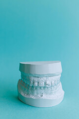 Plaster model of human teeth with transparent aligner, essix retainer or orthodontic silicone trainer