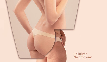 Collage. Cropped female body in underwear, buttocks and legs. Comparison of smooth and cellulite skin