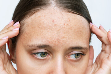 Cropped shot of young woman's face with acne problem, red allergic rash on a forehead. Allergies,...