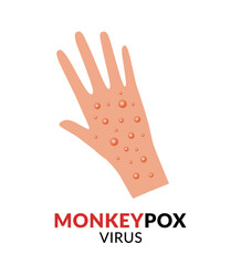 Hand with monkeypox flat design vector Illustration. Disease spread alert...Outbreak virus infections..