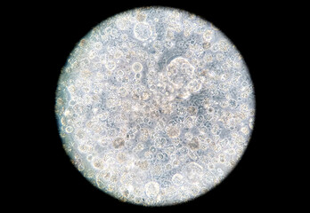 Human breast cancer cells cultured in vitro. Microscopic phase contrast image. Cancer cells are...