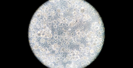 Human breast cancer cells cultured in vitro. Microscopic phase contrast image. Cancer cells are...