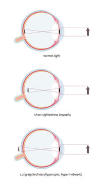 Myopia and hyperopia. Three common eye conditions: normal sight, short-sightedness (myopia) and long-sightedness (hyperopia, hypermetropia).