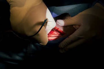 Surgery, surgeon hands, surgical gloves, wound, surgical wound. 