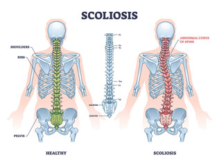 Scoliosis as medical sideways curvature illness of spine outline diagram. Labeled educational scheme with healthy and abdominal backbone skeleton comparison vector illustration. Deformity posture. - obrazy, fototapety, plakaty