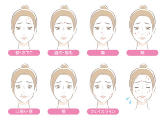 顔のニキビの出来やすい場所・女性