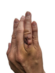 The finger was wound from surgery by a surgeon and was sutured. on a white background