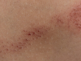 scratches on the skin as a background