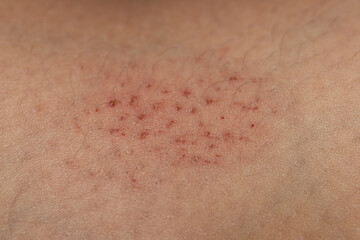 Fototapeta premium scratches on the skin as a background
