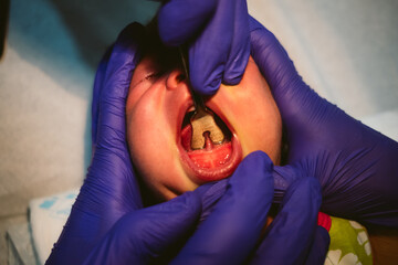 frenectomy surgery operation. Removal of lingual frenum or frenulum in newborn in surgeon operating...