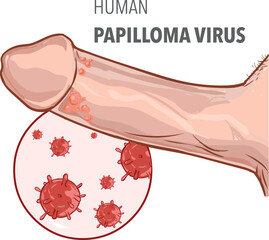 Vector illustration of human papilloma virus on penis - obrazy, fototapety, plakaty