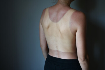 Obraz premium Young woman with sunburned back. Sun protection factor concept