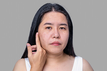 Close up of Asian adult woman face has freckles, large pores, blackhead pimple and scars problem...
