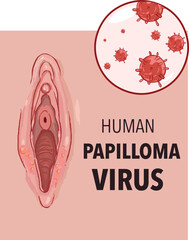 Vector illustration of human papilloma virus on female genitals