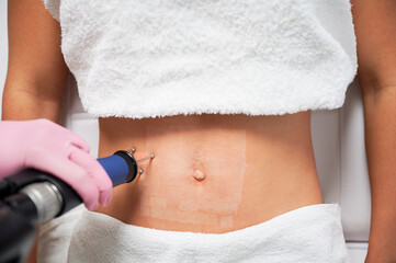 Close up of woman's abdomen exposed to laser polishing. Visible traces in form of white dots...
