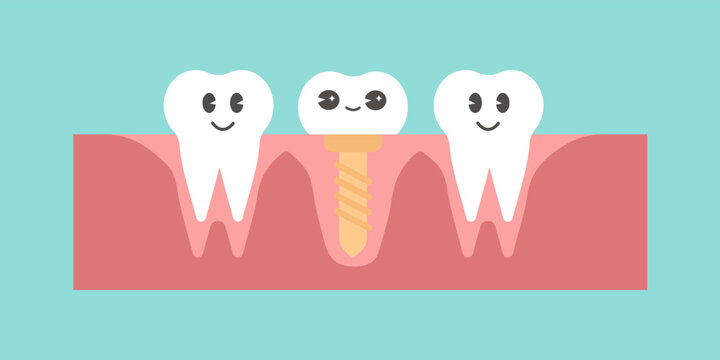 Dental Implant illustration, Tooth pin, Prosthetic dentistry image. Dental Care character. Vector flat design illustration 	

