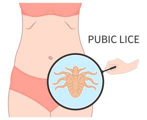 Pubic lice on body with tiny Bed Bugs tick egg infection - obrazy, fototapety, plakaty