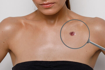 acne close-up on the female breast, problematic teenage skin - obrazy, fototapety, plakaty