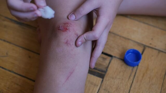 a teenager child independently treats a wound on his knee with a cotton swab and hydrogen peroxide. An abrasion on the knee of a child treated with an antiseptic by an independent teenager