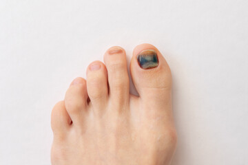 Subungual hematoma present under the toenail of the hallux, more commonly known as the big toe....