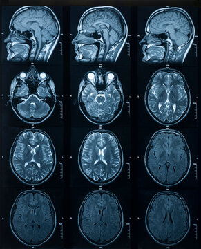 MRI scan of the brain. Medicine and Health