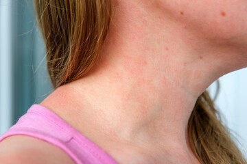 Allergic dermatitis on skin of woman's neck. Skin disease. Neurodermatitis disease, eczema or...