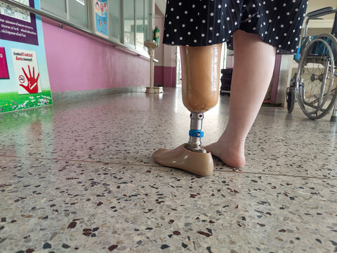 Disabled young women try to walk with prosthetics