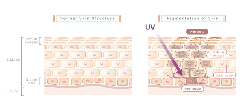 Vector skin structure illustration, comparison between healthy skin and skin pigmentation (age spot). Simple and best for educational and marketing materials.