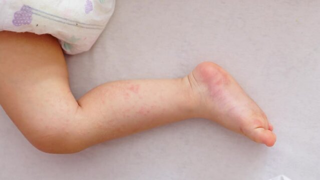 atopic eczema dermatitis sleeping baby legs, red irritation allergic disease. child kid lying on white bed showing red atopy skin rash on leg. dermatology allergy illness concept medicine and health