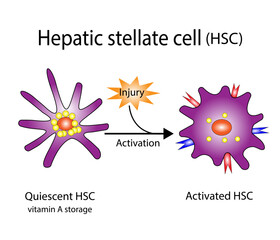 Hepatic stellate cell activation. Quiescent and activated HSCs. Hepatic fibrosis. vector illustration - obrazy, fototapety, plakaty
