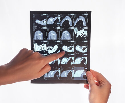 CT. Hand pointing to computerized tomography scan image. Doctor showing medical problem to patient. Diseases, injuries identification. High quality photo