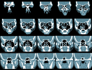 CT PARANASAL SINUSES WITH CONTRAST